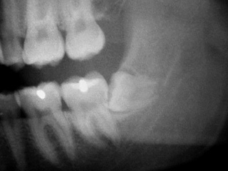 Zahnarzt München: minimalinvasive Entfernung eines verlagerten retinierten eingeklemmten Weisheitszahnes schmerzarm