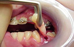 Zahnarzt München: kieferorthopädische Zahnextraktion bei Engstand 