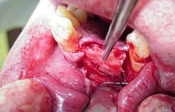Knochentransplantation für Zahnimplantat