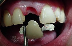 Zahnimplantat statt Brücke Frontzahnn