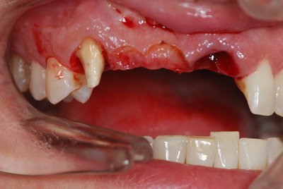 Sofortimplantat nach Verlust der Frontzahnbrücke Zähne unter Kronen waren verfault