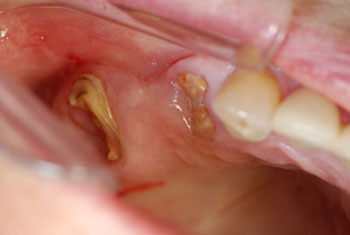 Zahnimplantation im Anschluss Zahnextraktion = Sofortimplantation vermeidet Knochenaufbau