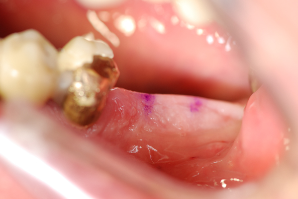 schmerzarme minimalinvasive Zahnimplantate vermeiden auch Knochenaufbau