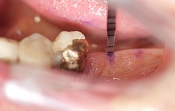 minimalinvasives Zahnimplantat winziges Bohrloch Knochenverdichtung