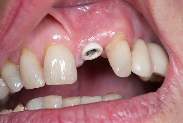 Vorgehen minimalinvasive Zahnoperation mit Sofortimplantat