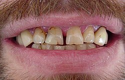 Zahnarzt München: grosses Diasthema Spalt zwischen Frontzähnen mit Kunststoff geschlossen
