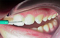 Zahnarzt München: Karies und Zahnfleischvorsorge Prophylaxe