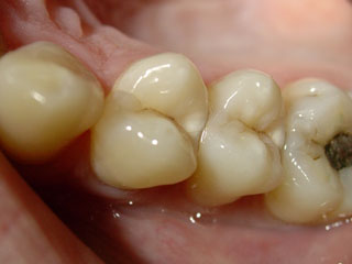 Zahnarzt München: wie entsteht Karies Zahnarzt München versteckter Zahnkaries unter gesunder Zahnoberfläche