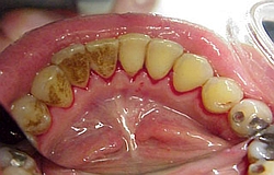 Zahnarzt München: professionelle Zahnreinigung befreit die Zähne von hässlichen Belägen