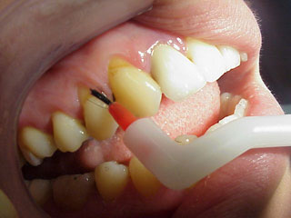 Zahnarzt München:empfindliche Zahnhälse Kälte Schmerz