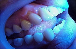 Zahnarzt München: empfindliche Zahnhälse die Nerven liegen blank