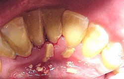 Zahnarzt München: Zahnstein mit Ultraschall entfernen