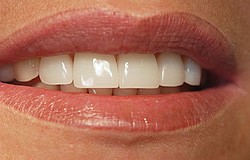Frontzahnverlust schnell wieder abgebrochenen Zahn ersetzen
