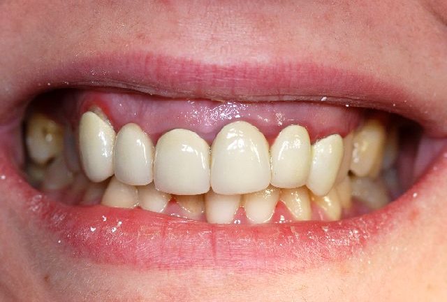 Zahnarzt München Zahnfleischlachen hohes Zahnfleisch gummy smile