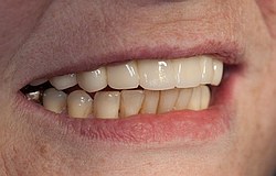 Übersicht Zahnersatz Zahnarzt München Dr.Junk