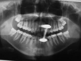 Zahnarzt München Röntgen mit Zungenpiercing
