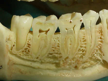 Zahnarzt München: So entsteht Karies ! Der dünne Schmelzmantel des Zahnes wird angegriffen- Die Bakterien arbeiten sich unerkannt bis zum Zahnnerv - dann tut´s höllisch weh Wurzelbehandlung.
