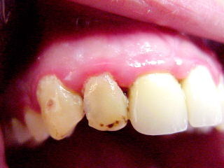 Zahnarzt München: Schmutz erzeugt Zahnfleisch Entzündungen, Putzen beugt vor